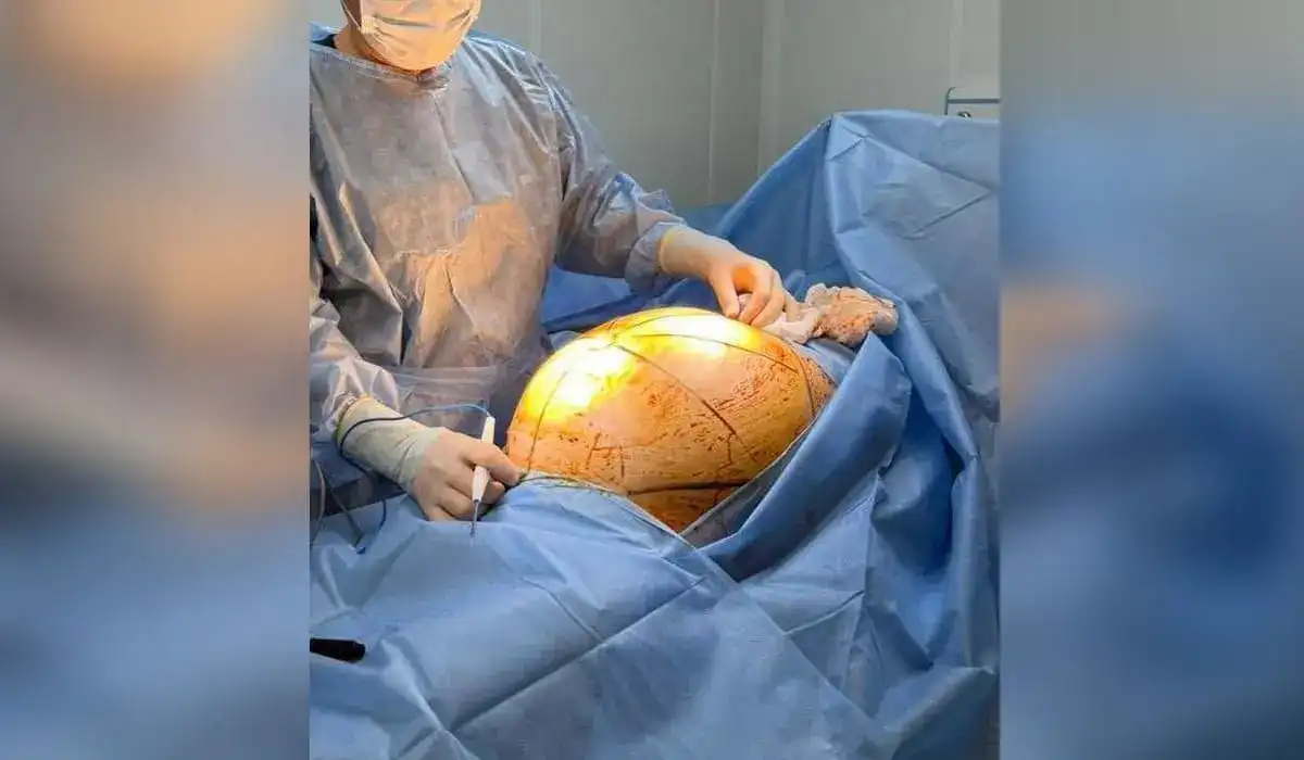 25 килограммов опухоли удалили у пациентки в Алматы