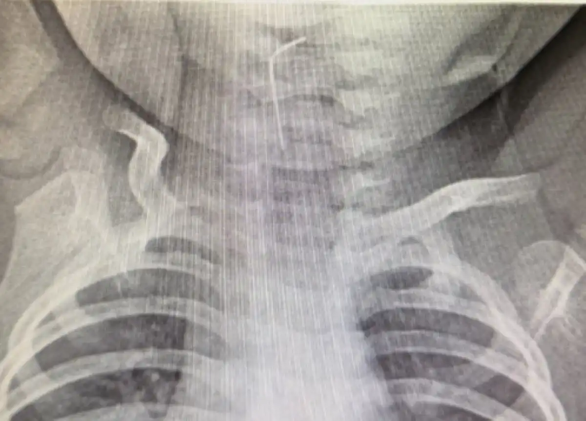 Игла застряла в пищеводе 9-месячного ребенка в Туркестанской области