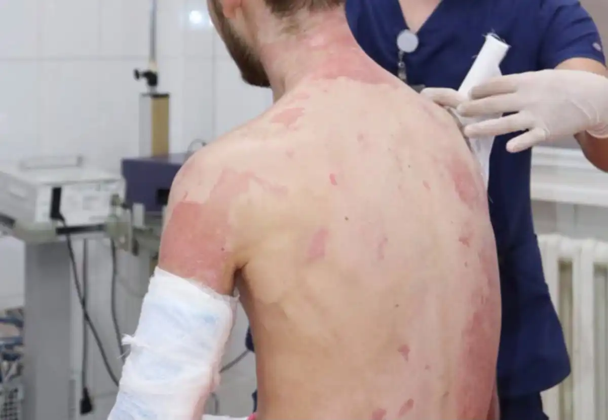В Алматы врачи спасли мужчину с ожогами по всему телу